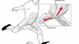 pubalgia